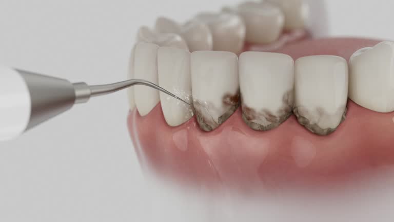 Trusted Dental Crowns And Bridges service in Port Angeles East, WA - Dentist Open Now
